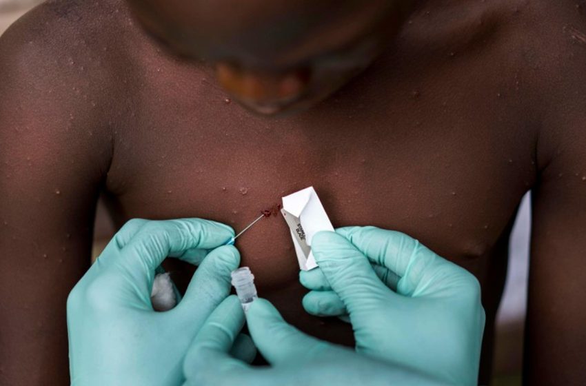 Le Kenya confirme un deuxième cas de Mpox